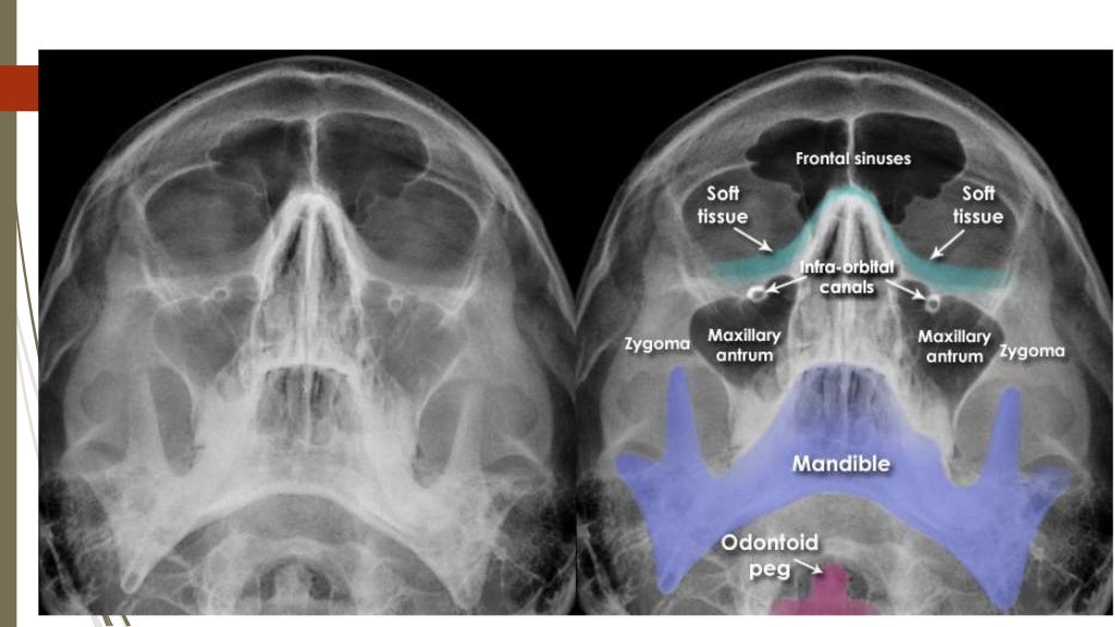 How To Read Facial Bone XRays By Peter Andre Soltau Jan2015