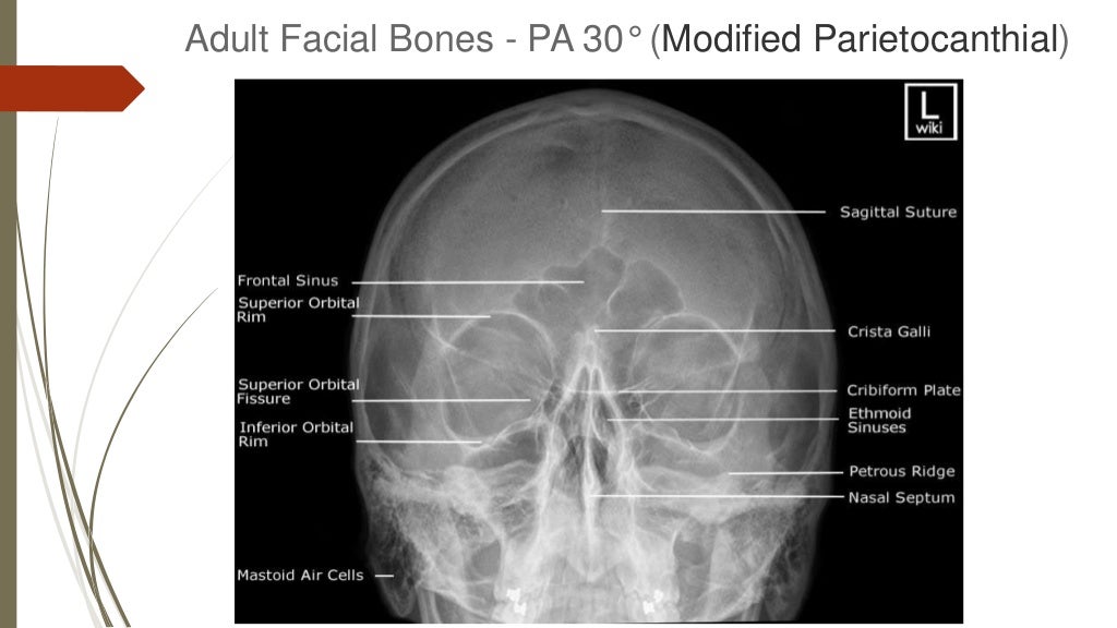 How To Read Facial Bone XRays By Peter Andre Soltau Jan2015