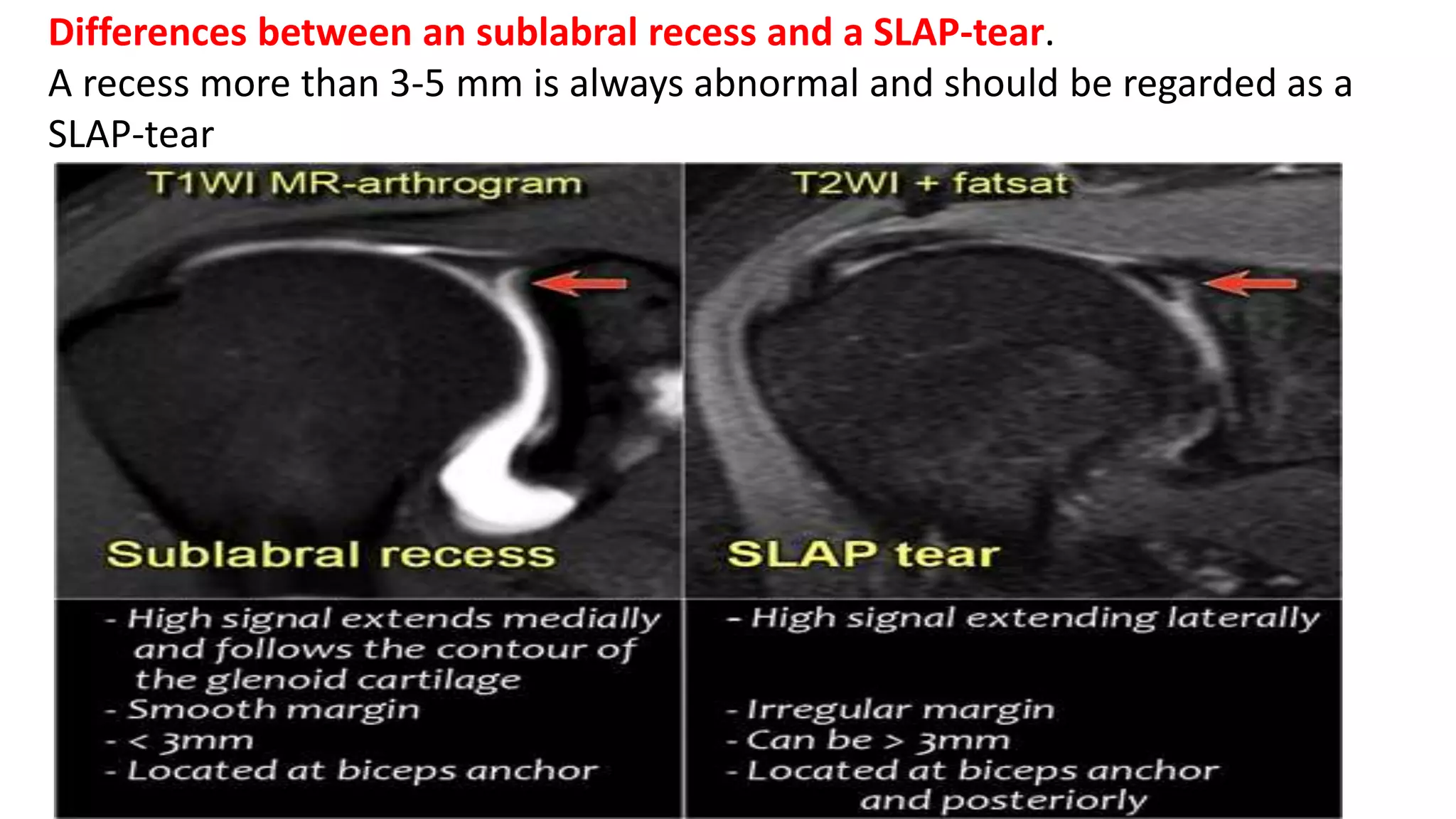 HOW TO READ SHOULDER MRI | PPTX