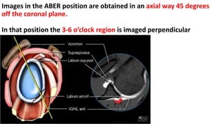 Images in the ABER position are obtained in an axial way 45 degrees
off the coronal plane.
In that position the 3-6 o’clock region is imaged perpendicular
 