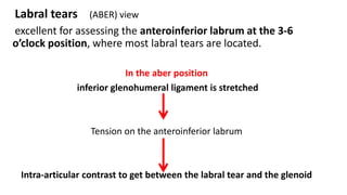 Labral tears (ABER) view
excellent for assessing the anteroinferior labrum at the 3-6
o’clock position, where most labral tears are located.
In the aber position
inferior glenohumeral ligament is stretched
Tension on the anteroinferior labrum
Intra-articular contrast to get between the labral tear and the glenoid
 