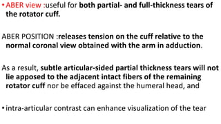•ABER view :useful for both partial- and full-thickness tears of
the rotator cuff.
ABER POSITION :releases tension on the cuff relative to the
normal coronal view obtained with the arm in adduction.
As a result, subtle articular-sided partial thickness tears will not
lie apposed to the adjacent intact fibers of the remaining
rotator cuff nor be effaced against the humeral head, and
•intra-articular contrast can enhance visualization of the tear
 