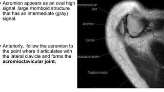 • Acromion appears as an oval high
signal ,large rhomboid structure
that has an intermediate (gray)
signal.
• Anteriorly, follow the acromion to
the point where it articulates with
the lateral clavicle and forms the
acromioclavicular joint.
 