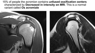 15% of people the acromion contains unfused ossification centers
characterized by Decreased in intensity on MRI. This is a normal
variant called Os acromiale
 