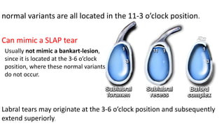 normal variants are all located in the 11-3 o’clock position.
Can mimic a SLAP tear
Usually not mimic a bankart-lesion,
since it is located at the 3-6 o’clock
position, where these normal variants
do not occur.
Labral tears may originate at the 3-6 o’clock position and subsequently
extend superiorly.
 