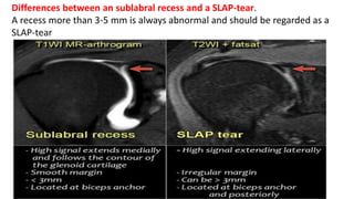 Differences between an sublabral recess and a SLAP-tear.
A recess more than 3-5 mm is always abnormal and should be regarded as a
SLAP-tear
 