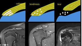 collagen tendinosis tear
 