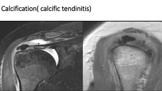 Calcification( calcific tendinitis)
 