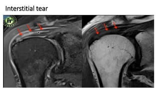 Interstitial tear
 