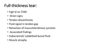 Full-thickness tear:
• high SI on T2WI
• Direct signs
• Tendon discontinuity
• Fluid signal in tendon gap
• Retraction of musculotendinous junction
• Associated findings
• Subacromial/ subdeltoid bursal fluid
• Muscle atrophy
 