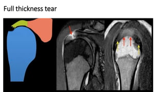 Full thickness tear
 