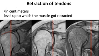 •In centimeters
level up to which the muscle got retracted
Retraction of tendons
 