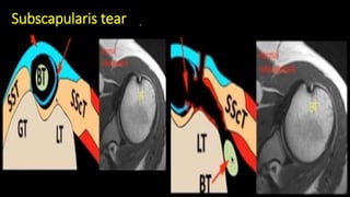 Subscapularis tear
 