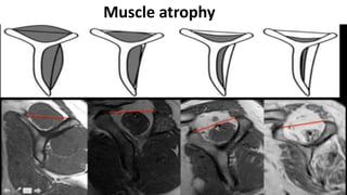 Muscle atrophy
 
