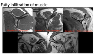 Fatty infiltration of muscle
 