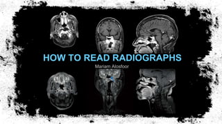 HOW TO READ RADIOGRAPHS
Mariam Alosfoor
 