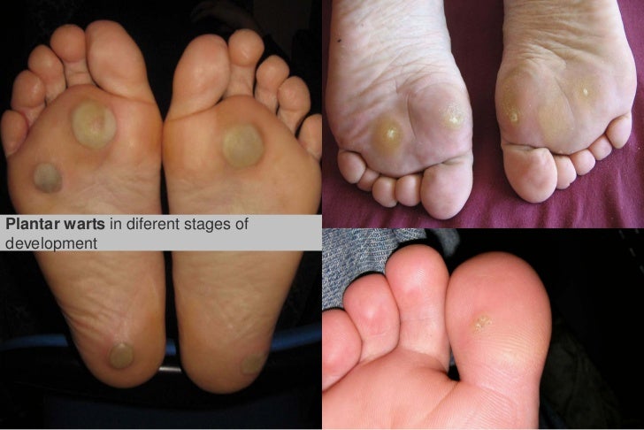 wart stages