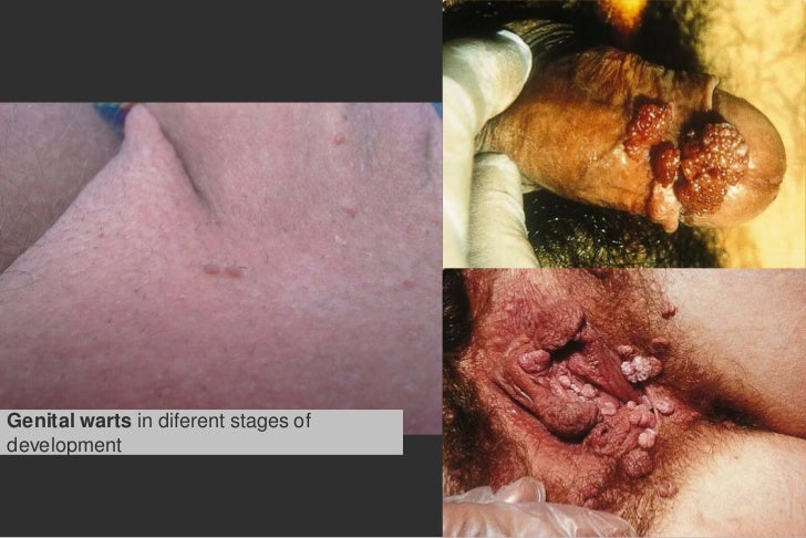 Genital warts on hands