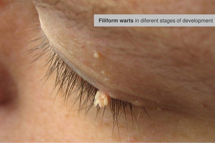 wart stages