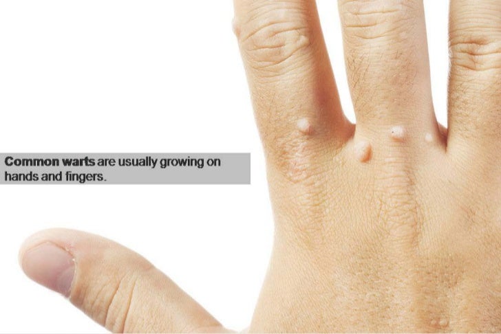 wart stages