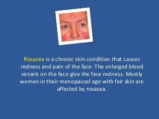 Rosacea is a chronic skin condition that causes
redness and pain of the face. The enlarged blood
vessels on the face give the face redness. Mostly
women in their menopausal age with fair skin are
affected by rosacea.
 