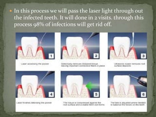  In this process we will pass the laser light through out
the infected teeth. It will done in 2 visits. through this
process 98% of infections will get rid off.
 
