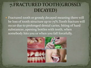  Fractured tooth or grossly decayed meaning there will
be loss of tooth structure up to 75%.Tooth fracture will
occur due to prolonged dental caries, biting of hard
substances ,opening bottles with teeth, when
somebody hits you or when you fall forcefully.
 