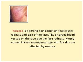 Rosacea is a chronic skin condition that causes
redness and pain of the face. The enlarged blood
vessels on the face give the face redness. Mostly
women in their menopausal age with fair skin are
affected by rosacea.
 