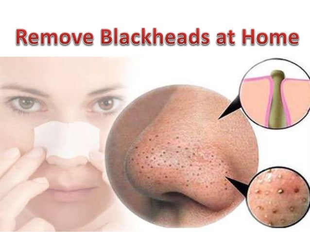 how to remove blackheads