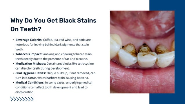 Exciting How To Remove Black Stains From Teeth Naturally Gallery