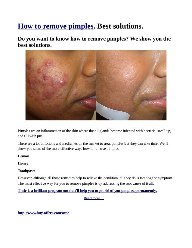 Best remedies to remove pimples or cystic acne.