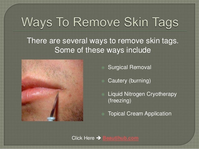 How To Remove Skin Tags At Home Without Pain Tags/csat