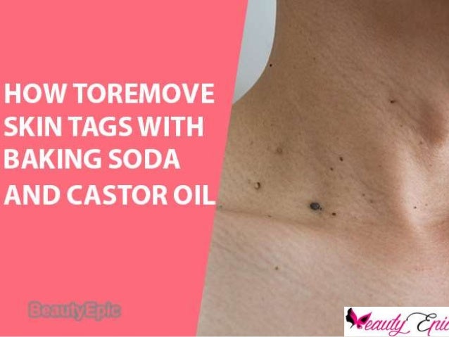How To Remove Skin Tags With Baking Soda And Castor Oil remove skin tags with baking soda