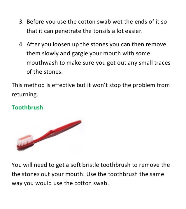 How to remove tonsil stones at home