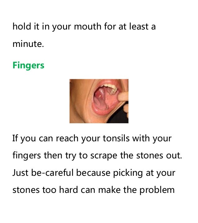How To Get Tonsil Stones Out Naturally How To Get Tonsil Stones Out Naturally
