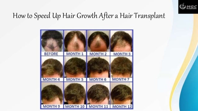 How To Speed Up Hair Growth After A Hair Transplant