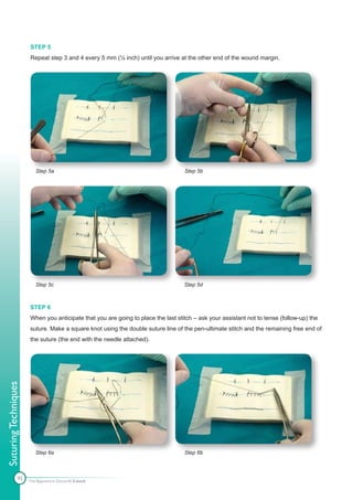 STEP 5
                      Repeat step 3 and 4 every 5 mm (¼ inch) until you arrive at the other end of the wound margin.




                         Step 5a                                                  Step 5b




                         Step 5c                                                  Step 5d



                      STEP 6
                      When you anticipate that you are going to place the last stitch – ask your assistant not to tense (follow-up) the
                      suture. Make a square knot using the double suture line of the pen-ultimate stitch and the remaining free end of
                      the suture (the end with the needle attached).
Suturing Techniques




                         Step 6a                                                  Step 6b



               95     The Apprentice Doctor® E-book
 