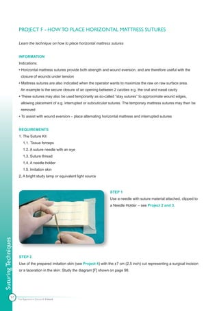PROJECT F - HOW TO PLACE HORIZONTAL MATTRESS SUTURES

                      Learn the technique on how to place horizontal mattress sutures


                      INFORMATION
                      Indications:
                      • Horizontal mattress sutures provide both strength and wound eversion, and are therefore useful with the
                        closure of wounds under tension
                      • Mattress sutures are also indicated when the operator wants to maximize the raw on raw surface area.
                        An example is the secure closure of an opening between 2 cavities e.g. the oral and nasal cavity
                      • These sutures may also be used temporarily as so-called “stay sutures” to approximate wound edges,
                        allowing placement of e.g. interrupted or subcuticular sutures. The temporary mattress sutures may then be
                        removed
                      • To assist with wound eversion – place alternating horizontal mattress and interrupted sutures


                      REQUIREMENTS
                      1. The Suture Kit
                          1.1. Tissue forceps
                          1.2. A suture needle with an eye
                          1.3. Suture thread
                          1.4. A needle holder
                          1.5. Imitation skin
                      2. A bright study lamp or equivalent light source



                                                                               STEP 1
                                                                               Use a needle with suture material attached, clipped to
                                                                               a Needle Holder – see Project 2 and 3.
Suturing Techniques




                      STEP 2
                      Use of the prepared imitation skin (see Project 4) with the ±7 cm (2,5 inch) cut representing a surgical incision
                      or a laceration in the skin. Study the diagram [F] shown on page 98.




               97     The Apprentice Doctor® E-book
 