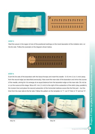 STEP 3
Start the suture in the region of one of the positional markings on the mock laceration of the imitation skin, on
the far side. Follow the example on the diagram shown below.




                                                                                                                               Project F: How to place horizontal mattress sutures
STEP 4
Evert the far side of the laceration with the tissue forceps and insert the needle - 5-10 mm (¼ to ½ inch) away
from the wound edge (as described previously). Now evert the near side of the laceration and mirror the course
of the needle, aiming for it to emerge at an equal distance from the laceration edge on the near side. Do not tie
or cut the suture at this stage. Move 4/5 mm (¼ inch) to the right of this subsection of the stitch (stay parallel to
the incision line) and place the second subsection of the horizontal mattress suture like the first part – but this
time from the near side to the far side. Follow the pattern on the template: In “1”, out “2” then in “3” and out “4”.




  Step 4a                                                     Step 4b




                                                                                                                               98
                                                                                               The Apprentice Doctor® E-book
 