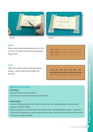 Step 5b                                                   Step 5c




STEP 6
Place a second horizontal mattress suture ±3-4 mm
(⅛ inch) to the right of the first suture by repeating
Steps 4 and 5.




                                                                                                                              Project F: How to place horizontal mattress sutures
STEP 7
Follow with another couple of horizontal mattress
sutures – until you reach the right edge of the
laceration.




  POINTS OF INTEREST
  Advantages:
  • Improved eversion may be achieved
  • Can be used in wounds under a fair amount of tension


  Disadvantages:
  • High risk of producing suture marks if left in place for too long – especially where the suture exerts
   pressure on the skin surface
  • High risk of tissue in the wound edge dying (necrosis) due to compromised blood supply – especially if
   they are tied too tightly. Do not place these sutures too close to the wound edges and consider removing
   the sutures as early as possible.




                                                                                                                             100
                                                                                             The Apprentice Doctor® E-book
 