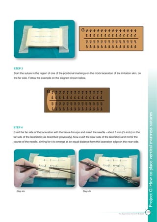 STEP 3
Start the suture in the region of one of the positional markings on the mock laceration of the imitation skin, on
the far side. Follow the example on the diagram shown below.




                                                                                                                              Project G: How to place vertical mattress sutures
STEP 4
Evert the far side of the laceration with the tissue forceps and insert the needle - about 5 mm (¼ inch) on the
far side of the laceration (as described previously). Now evert the near side of the laceration and mirror the
course of the needle, aiming for it to emerge at an equal distance form the laceration edge on the near side.




  Step 4a                                                    Step 4b




                                                                                                                             102
                                                                                             The Apprentice Doctor® E-book
 