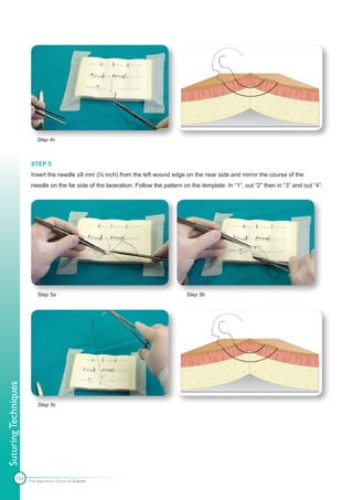 Step 4c



                       STEP 5
                       Insert the needle ±8 mm (⅜ inch) from the left wound edge on the near side and mirror the course of the
                       needle on the far side of the laceration. Follow the pattern on the template: In “1”, out “2” then in “3” and out “4”.




                          Step 5a                                                    Step 5b
Suturing Techniques




                          Step 5c




            103       The Apprentice Doctor® E-book
 