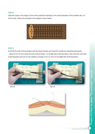 STEP 3
Start the suture in the region of one of the positional markings on the mock laceration of the imitation skin, on
the far side. Follow the example on the diagram shown below.




STEP 4
Evert the far side of the laceration with the tissue forceps and insert the needle (as described preciously)
– about 8 mm (⅜ inch) away from the wound margin - on the far side of the laceration. Now evert the near side
of the laceration and aim for the needle to emerge 5 mm (¼ inch) on the near side of the laceration.




                                                                                                                              Project H: How to place “Far-and-near” sutures
  Step 4a                                                    Step 4b




                                                                                                                             106
                                                                                             The Apprentice Doctor® E-book
 