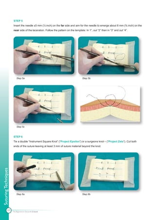 STEP 5
                       Insert the needle ±5 mm (¼ inch) on the far side and aim for the needle to emerge about 8 mm (⅜ inch) on the
                       near side of the laceration. Follow the pattern on the template: In 1”, out “2” then in “3” and out “4”.




                          Step 5a                                                    Step 5b




                          Step 5c



                      STEP 6
                      Tie a double “Instrument Square Knot” (“Project Epsilon”) or a surgeons knot – (“Project Zeta”). Cut both
                      ends of the suture leaving at least 3 mm of suture material beyond the knot.
Suturing Techniques




                          Step 6a                                                    Step 6b




            107
                      The Apprentice Doctor® E-book
 