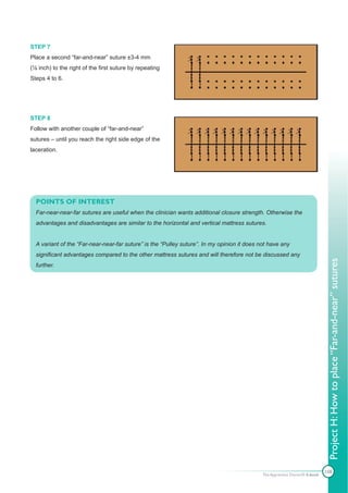 STEP 7
Place a second “far-and-near” suture ±3-4 mm
(⅛ inch) to the right of the first suture by repeating
Steps 4 to 6.




STEP 8
Follow with another couple of “far-and-near”
sutures – until you reach the right side edge of the
laceration.




  POINTS OF INTEREST
  Far-near-near-far sutures are useful when the clinician wants additional closure strength. Otherwise the
  advantages and disadvantages are similar to the horizontal and vertical mattress sutures.


  A variant of the “Far-near-near-far suture” is the “Pulley suture”. In my opinion it does not have any
  significant advantages compared to the other mattress sutures and will therefore not be discussed any




                                                                                                                              Project H: How to place “Far-and-near” sutures
  further.




                                                                                             The Apprentice Doctor® E-book
                                                                                                                             108
 