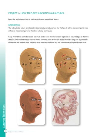 PROJECT I - HOW TO PLACE SUBCUTICULAR SUTURES

                      Learn the technique on how to place a continuous subcuticular suture


                      INFORMATION
                      The subcuticular suture is indicated in cosmetically sensitive areas like the face. It is time-consuming and more
                      difficult to master compared to the other suturing techniques.


                      Keep in mind that cosmetic results are much better when minimal tension is placed on wound edges at the time
                      of repair. The most favorable wounds from a cosmetic point of view are those where the long axis is parallel to
                      the natural skin tension lines. Repair of such a wound will result in a fine cosmetically acceptable linear scar.
Suturing Techniques




            109       The Apprentice Doctor® E-book
 
