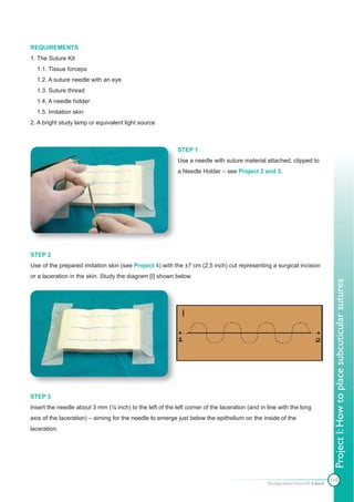 REQUIREMENTS
1. The Suture Kit
  1.1. Tissue forceps
  1.2. A suture needle with an eye
  1.3. Suture thread
  1.4. A needle holder
  1.5. Imitation skin
2. A bright study lamp or equivalent light source



                                                           STEP 1
                                                           Use a needle with suture material attached, clipped to
                                                           a Needle Holder – see Project 2 and 3.




STEP 2
Use of the prepared imitation skin (see Project 4) with the ±7 cm (2,5 inch) cut representing a surgical incision
or a laceration in the skin. Study the diagram [I] shown below.




                                                                                                                                Project I: How to place subcuticular sutures




STEP 3
Insert the needle about 3 mm (⅛ inch) to the left of the left corner of the laceration (and in line with the long
axis of the laceration) – aiming for the needle to emerge just below the epithelium on the inside of the
laceration.




                                                                                                                               110
                                                                                               The Apprentice Doctor® E-book
 