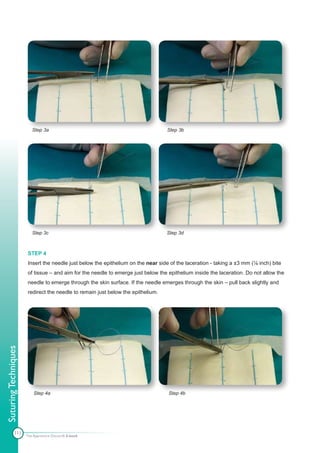 Step 3a                                                 Step 3b




                         Step 3c                                                 Step 3d



                      STEP 4
                      Insert the needle just below the epithelium on the near side of the laceration - taking a ±3 mm (⅛ inch) bite
                      of tissue – and aim for the needle to emerge just below the epithelium inside the laceration. Do not allow the
                      needle to emerge through the skin surface. If the needle emerges through the skin – pull back slightly and
                      redirect the needle to remain just below the epithelium.
Suturing Techniques




                          Step 4a                                                 Step 4b




            111
                      The Apprentice Doctor® E-book
 