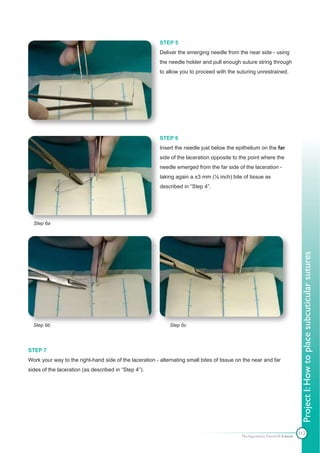 STEP 5
                                                         Deliver the emerging needle from the near side - using
                                                         the needle holder and pull enough suture string through
                                                         to allow you to proceed with the suturing unrestrained.




                                                         STEP 6
                                                         Insert the needle just below the epithelium on the far
                                                         side of the laceration opposite to the point where the
                                                         needle emerged from the far side of the laceration -
                                                         taking again a ±3 mm (⅛ inch) bite of tissue as
                                                         described in “Step 4”.




  Step 6a




                                                                                                                             Project I: How to place subcuticular sutures
  Step 6b                                                    Step 6c




STEP 7
Work your way to the right-hand side of the laceration - alternating small bites of tissue on the near and far
sides of the laceration (as described in “Step 4”).




                                                                                                                            112
                                                                                            The Apprentice Doctor® E-book
 