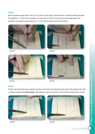 STEP 8
When needle emerges within 3 mm (⅛ inch) from the left edge of the laceration, insert the needle just below
the epithelium – but aim for the needle to emerge about 3 mm (⅛ inch) away from the right edge of the
laceration emerging through healthy skin – in line with the long axis of the laceration.




 Step 8a                                                     Step 8b




                                                                                                                            Project I: How to place subcuticular sutures
 Step 8c                                                     Step 8d


STEP 9
Pull the two ends of the suture tightly away from each other and strap the loose ends to the adjacent skin with
a suitable strapping like Steri-strips®. Alternatively, make a knot at both ends of the emerging suture thread.




  Step 9a                                                    Step 9b



                                                                                                                           114
                                                                                           The Apprentice Doctor® E-book
 
